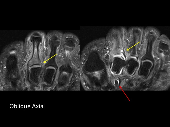 Figure 2 for case plantar plate of metatarsophalangeal joint ( RID3134 )